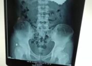 Ngeri, Diduga Kena Santet Dokter Temukan 70 Paku dalam Lambung Pria Ini
