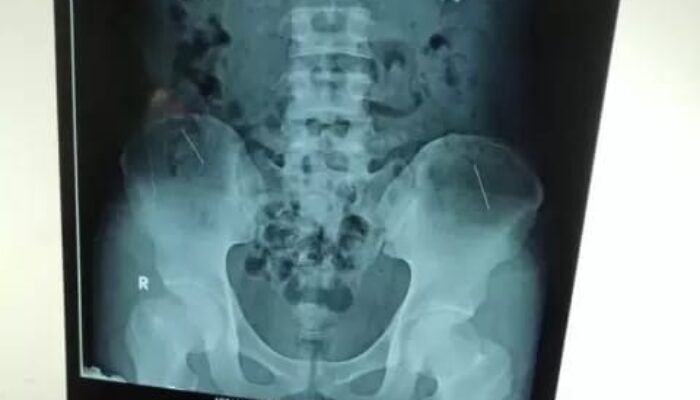 Ngeri, Diduga Kena Santet Dokter Temukan 70 Paku dalam Lambung Pria Ini